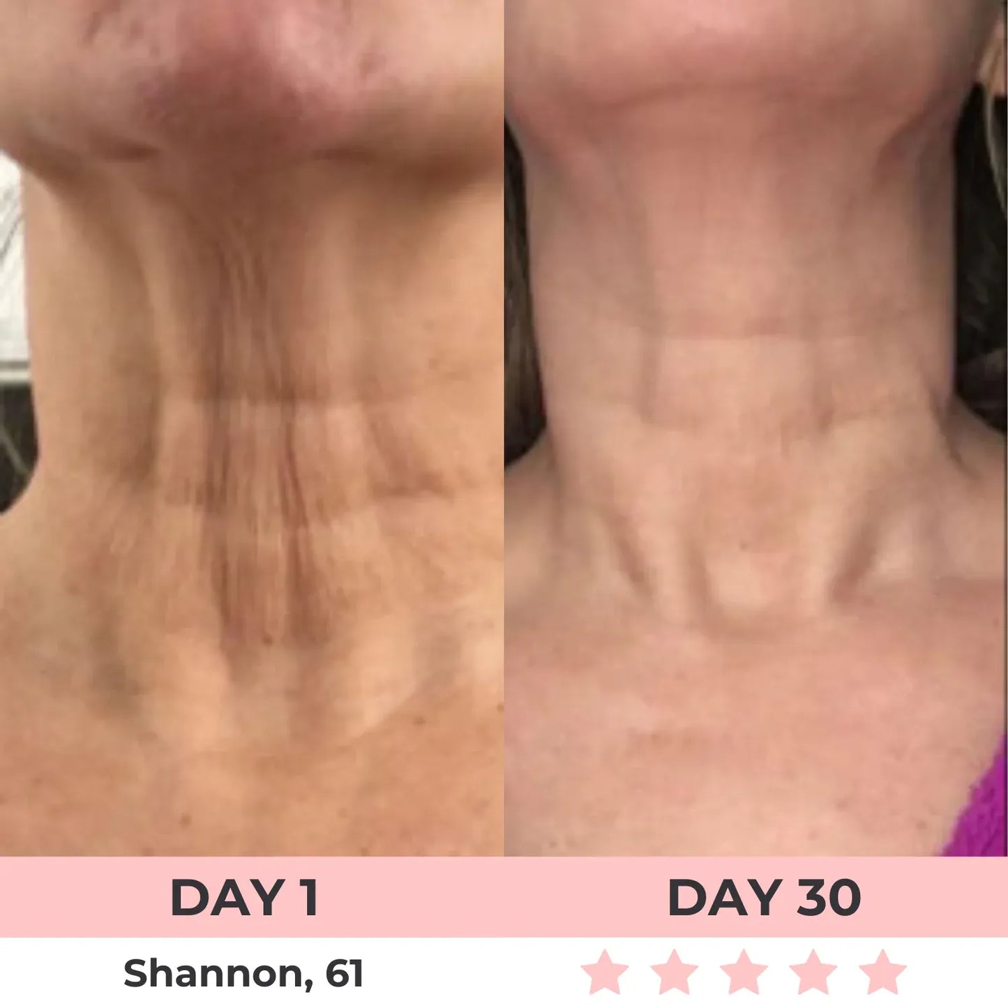 skinrenowa device